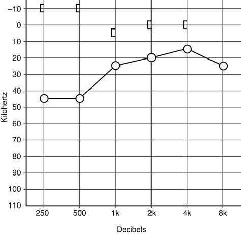 Superior Semicircular Canal Dehiscence Syndrome - Clinical Tree