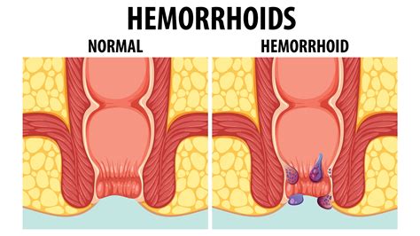 Piles and Your Health: Causes, Symptoms & Treatment Options