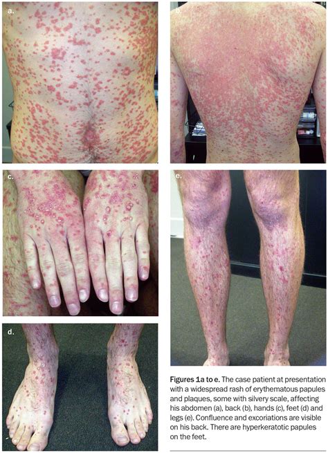 A man with a rapidly evolving, widespread pruritic rash | Medicine Today