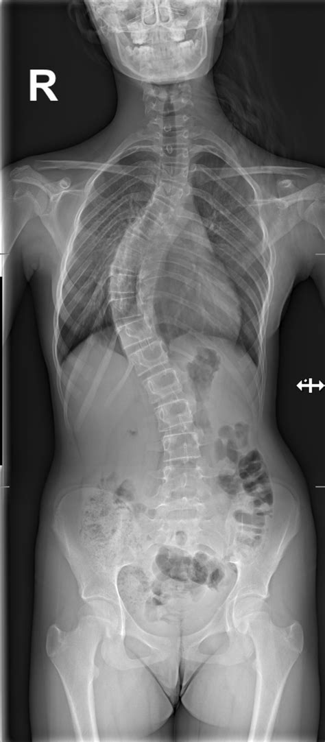 Escoliosis, ¿qué es?¿cómo se trata? - Instituto Cirugía de Columna