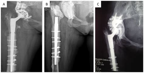 Partial Two-Stage Exchange for Infected Total Hip Arthroplasty: A Treatment to Take into Account - what is arthroplasty