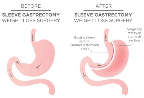 Consent: Sleeve Gastrectomy - TeachMeSurgery