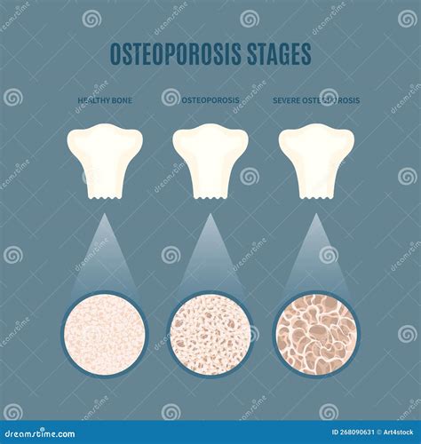 Osteoporosis Bone Density Loss Disease Medical Infographics Stock ...