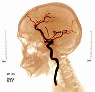 cerebrovascular 的图像结果