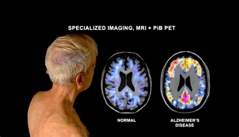 Lewy Body Dementia Behavior at Mary Langan blog - phases of lewy body dementia