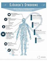 Types Of Sjogrens Syndrome