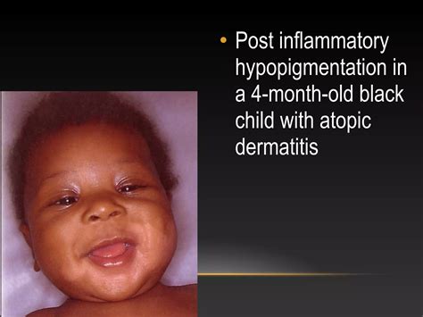 Disorders of pigmentation | PPT