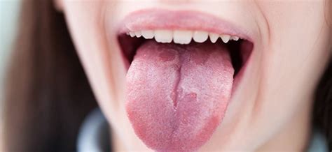 Glositis migratoria benigna o lengua geográfica | Blogs Quirónsalud