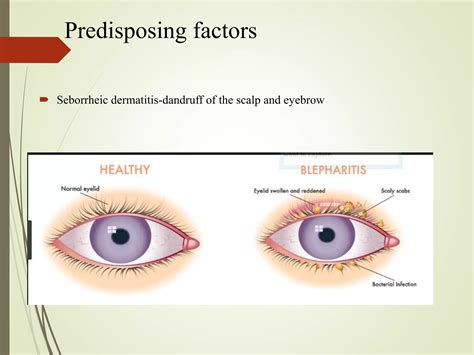 Blepharitis Vs Stye