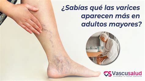 ¿Varices más frecuentes en los adultos mayores?