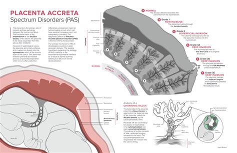 Placenta Accreta Spectrum Disorders on Behance