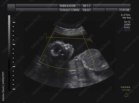 Ultrasound 的图像结果