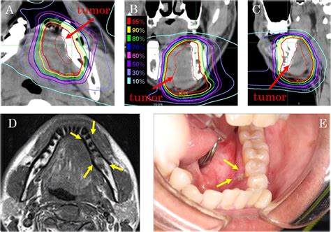 Clinical features and dosimetric evaluation of carbon ion radiation-induced osteoradionecrosis ...