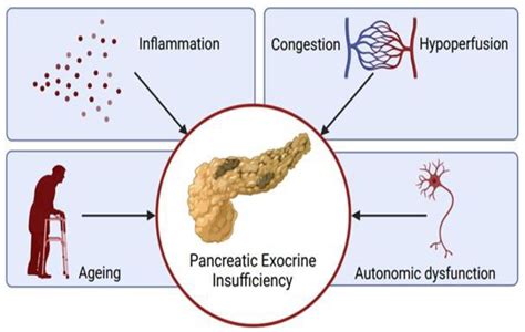 What To Eat With Exocrine Pancreatic Insufficiency at Stephen Gallagher ...