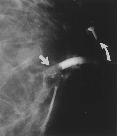 Incidental Treatment of Nipple Discharge Caused by Benign Intraductal ...