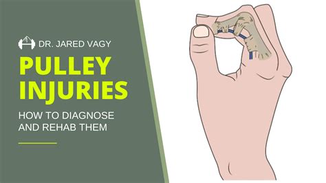 Finger Sprain Exercises