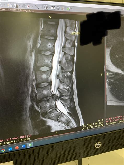 Bulging Disc Surgery 的图像结果