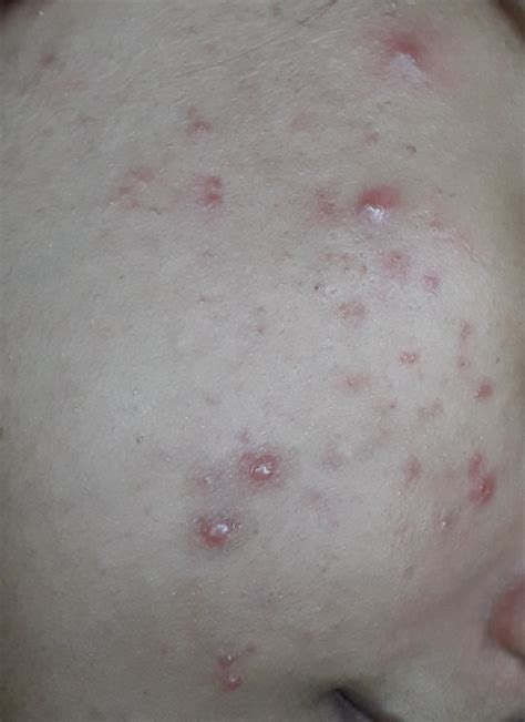 Ask a Gynecologist Online for Hormonal Acne And Period Issue