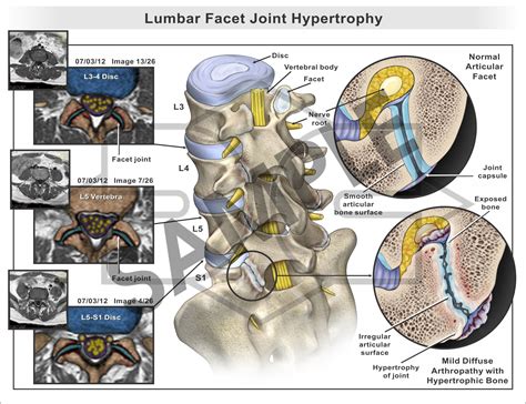 Facet Joint Hypertrophic at Jerry Cook blog