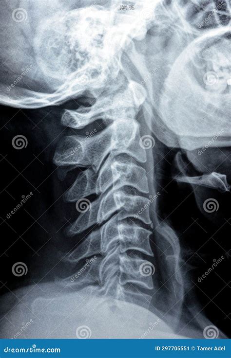 Plain X Ray of Cervical Spine Revealed Straightened Cervical Curve, Spondylosis Osteophytic ...