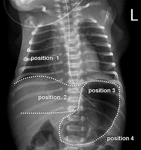 Improved radiological assessment of neonatal feeding tubes | ADC Fetal & Neonatal Edition
