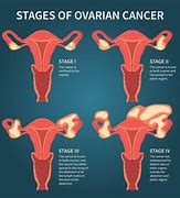 ovarian 的图像结果