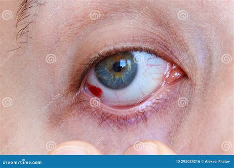 Close Up of a Bloodshot Eye Man. Hemorrhage of the Eye, Rupture of a Vessel in the Eye, Blood in ...