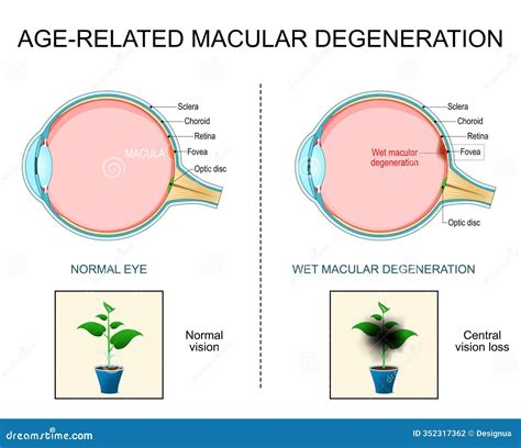 Wet Age-related Macular Degeneration AMD Stock Illustration - Illustration of retinal, sclera ...