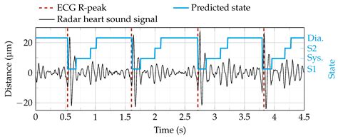A Clinically Evaluated Interferometric Continuous-Wave Radar System for ...