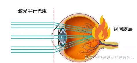 激光灯照射眼，黄斑区灼伤，视力突降能恢复以前吗？ - 知乎