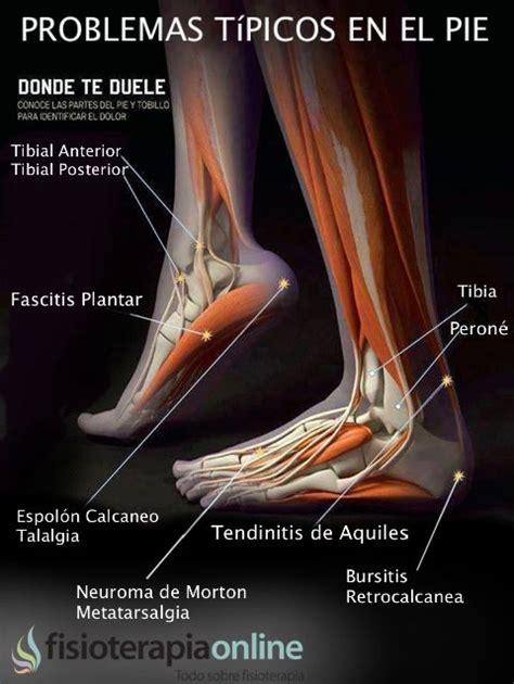 Tendinitis de tibial anterior, tibial posterior y peroneos: Artículos ...