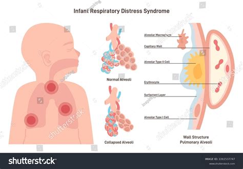 Respiratory Distress: Over 970 Royalty-Free Licensable Stock Vectors ...