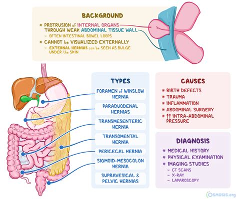 Hernias Of The Abdomen - FDPLEARN