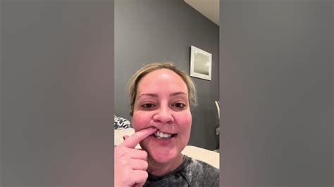 Recovery story while jaw wired shut - eating and talking advice - YouTube