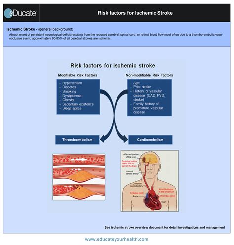 Risk factors for Ischemic Stroke QR - eDucateYourHealthOnline