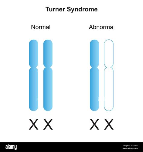 Turners Syndrome Monosomy