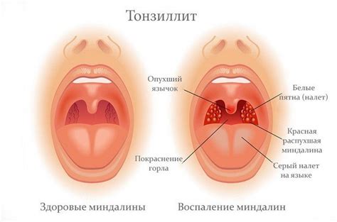 Заболевания горла и гортани: симптомы и лечение - Клиника ЦМЭИ