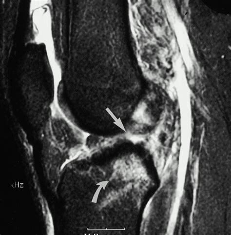 Bone Contusion Patterns of the Knee at MR Imaging: Footprint of the ...