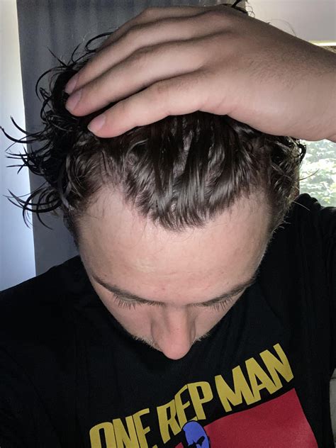 Normal Hairline Vs Receding