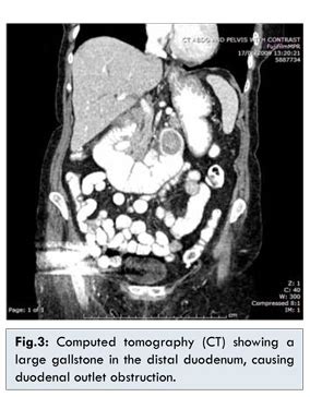 Management Options of Bouveret’s Syndrome