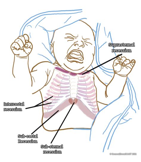 Abdominal Respiration In Infants