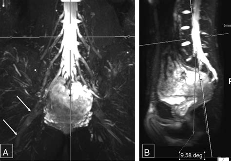 3D MR Neurography of the Lumbosacral Plexus: Obtaining Optimal Images for Selective Longitudinal ...
