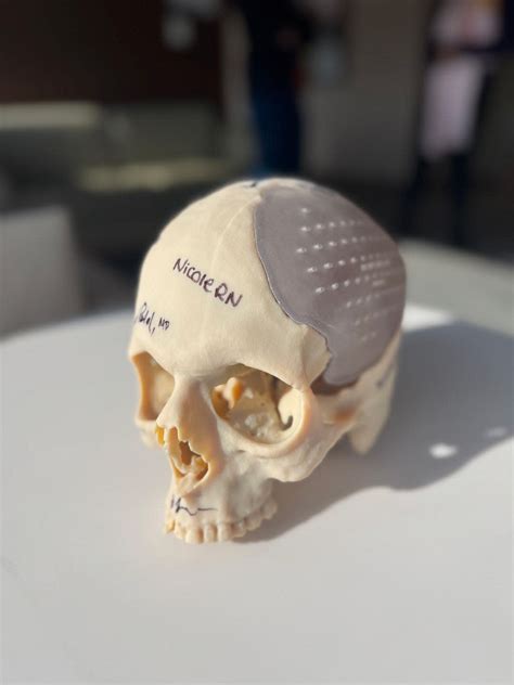 I Survived Losing Nearly Half My Skull. My Lifesaver: A 3D-Printed Skull.