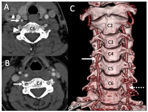 Vertebral Artery