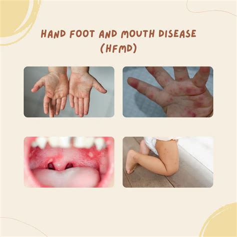 Why Is My Child’s Skin Peeling After HFMD? - FirstStep Child Specialist ...