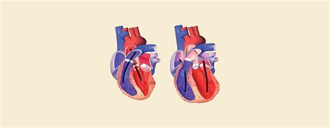 Difference Between Systolic vs Diastolic Heart Failure – Knya