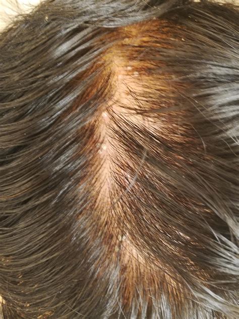 Zits On Scalp Reasons Behind Pimples On Scalp