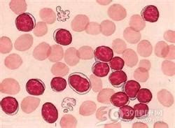 白细胞减少症和粒细胞缺乏症_白细胞减少症和粒细胞缺乏症的症状，治疗，好评专家_疾病查询_39疾病百科