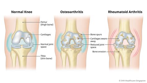Knee Arthritis - Symptoms & Causes | Parkway East Hospital