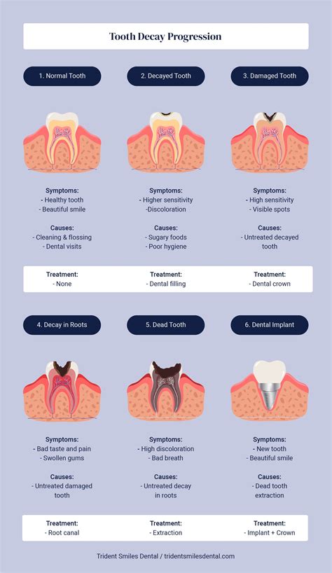 Trident Smiles Dental | The various stages of tooth decay (with infographic)
